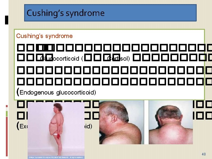 Cushing’s syndrome ���������� Glucocorticoid (���� Cortisol) ��������������� (Endogenous glucocorticoid) ��������������������� (Exogenous glucocorticoid) 48 