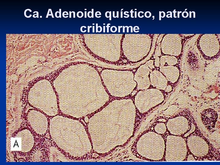 Ca. Adenoide quístico, patrón cribiforme 