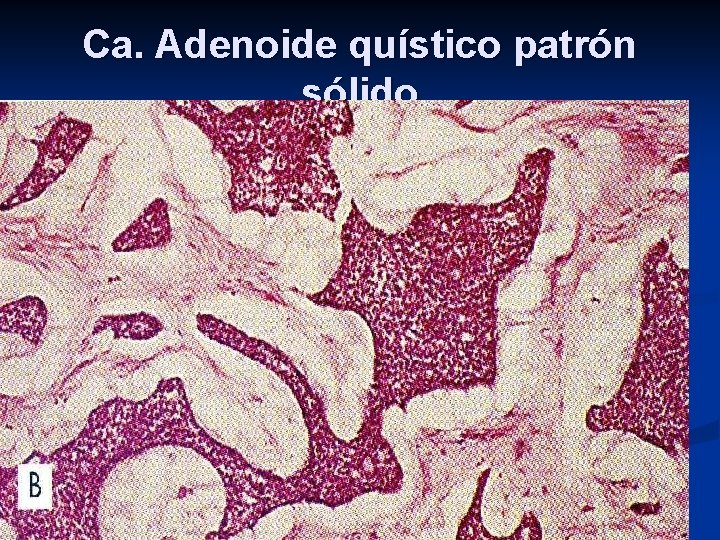 Ca. Adenoide quístico patrón sólido 