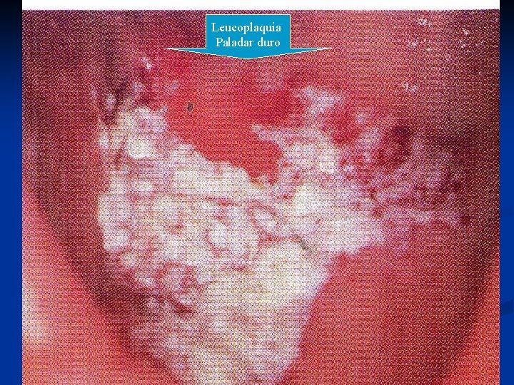 Leucoplaquia Paladar duro 