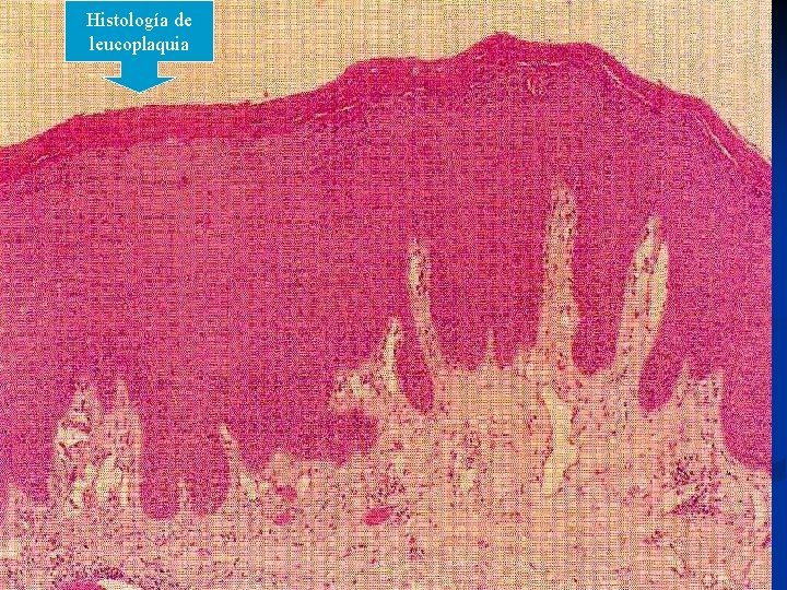 Histología de leucoplaquia 