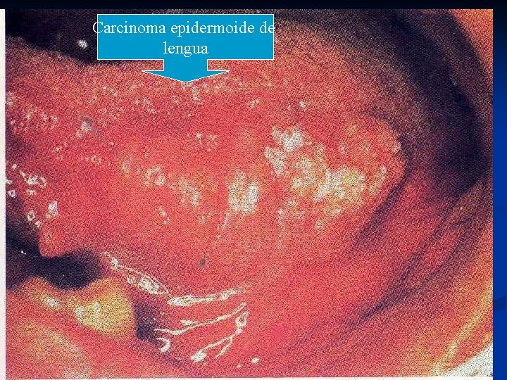 Carcinoma epidermoide de lengua 