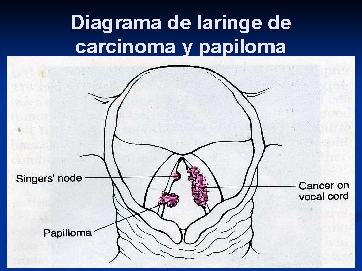 Diagrama de laringe de carcinoma y papiloma 