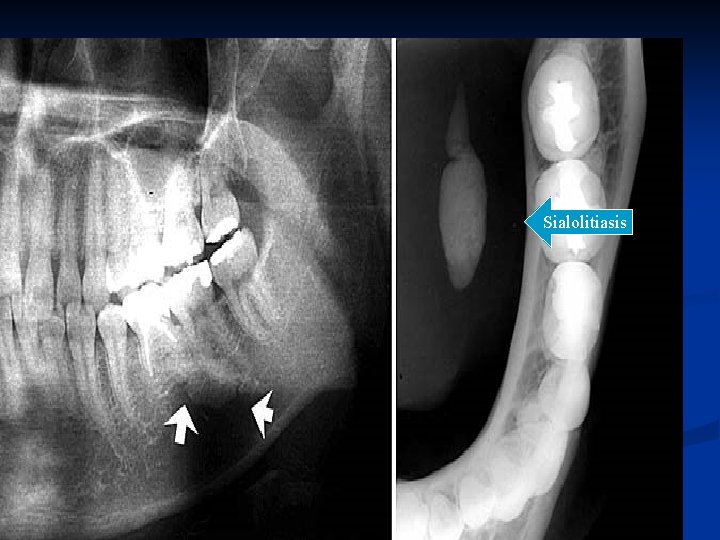 Sialolitiasis 