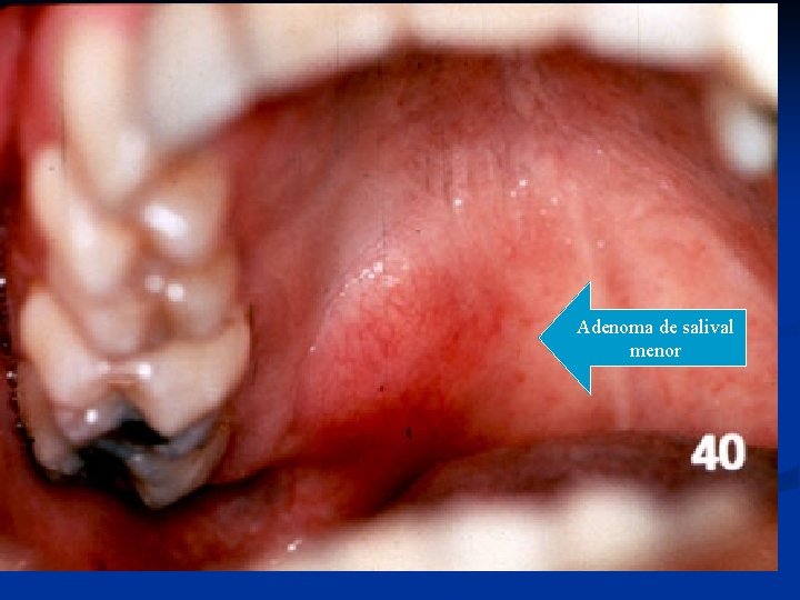 Adenoma de salival menor 