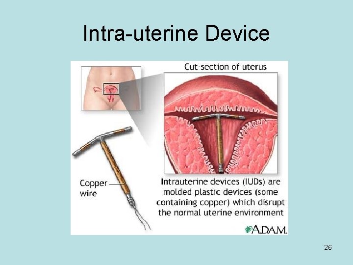 Intra-uterine Device 26 