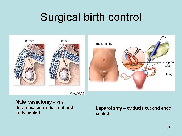 Surgical birth control Male vasectomy – vas deferens/sperm duct cut and ends sealed Laparotomy