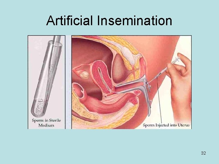 Artificial Insemination 32 