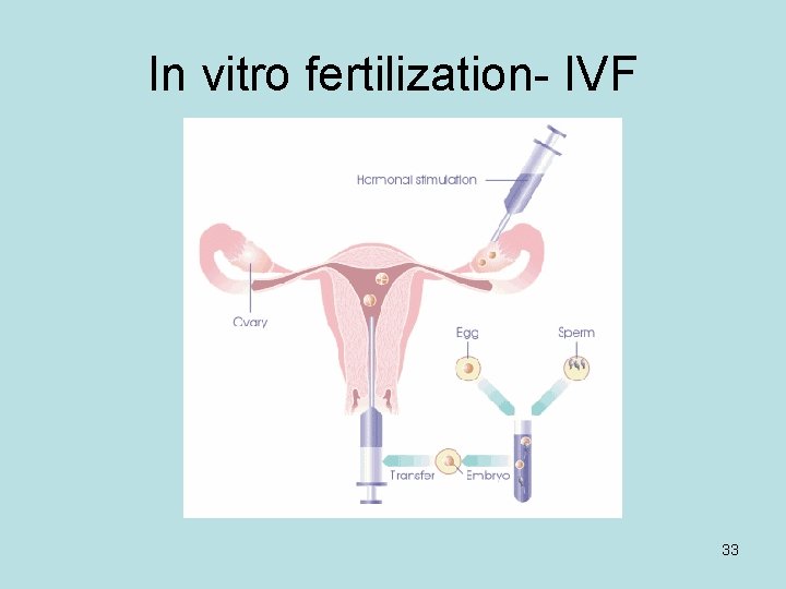 In vitro fertilization- IVF 33 