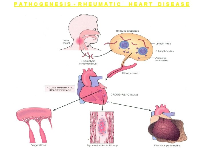 PATHOGENESIS - RHEUMATIC HEART DISEASE 