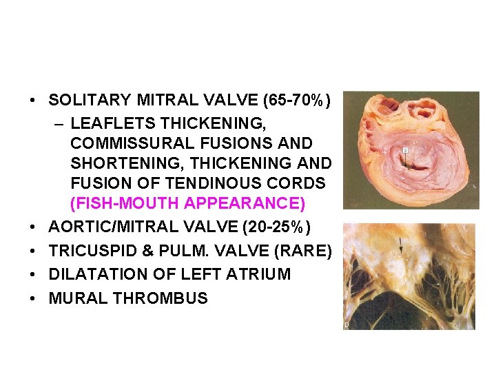 MORPHOLOGY-CHRONIC RHD • SOLITARY MITRAL VALVE (65 -70%) – LEAFLETS THICKENING, COMMISSURAL FUSIONS AND