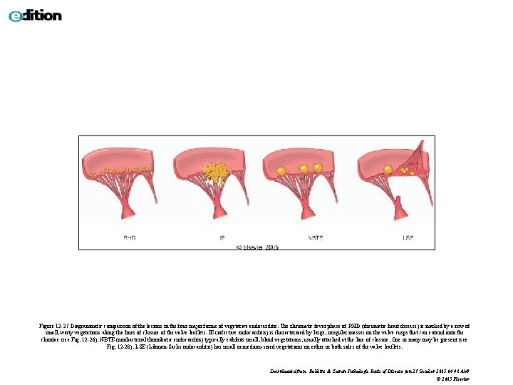 Figure 12 -27 Diagrammatic comparison of the lesions in the four major forms of