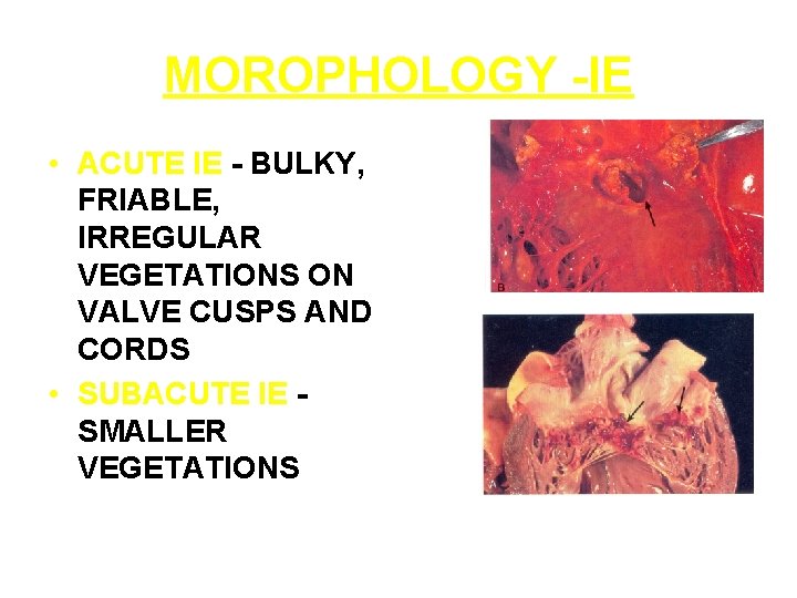 MOROPHOLOGY -IE • ACUTE IE - BULKY, FRIABLE, IRREGULAR VEGETATIONS ON VALVE CUSPS AND