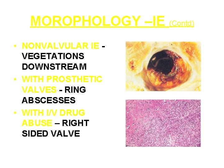 MOROPHOLOGY –IE (Contd) • NONVALVULAR IE VEGETATIONS DOWNSTREAM • WITH PROSTHETIC VALVES - RING