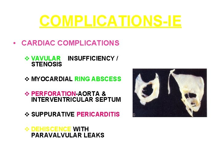 COMPLICATIONS-IE • CARDIAC COMPLICATIONS v VAVULAR INSUFFICIENCY / STENOSIS v MYOCARDIAL RING ABSCESS v