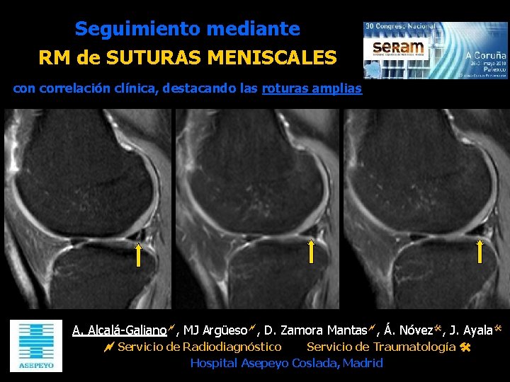 Seguimiento mediante RM de SUTURAS MENISCALES con correlación clínica, destacando las roturas amplias A.