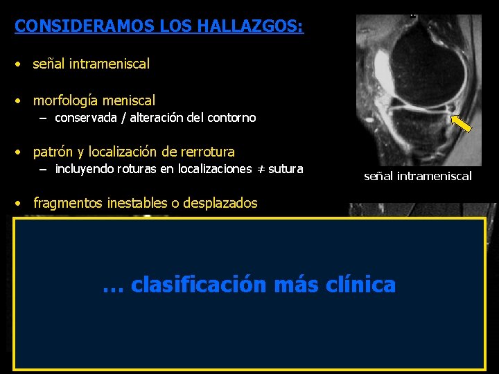 CONSIDERAMOS LOS HALLAZGOS: • señal intrameniscal • morfología meniscal – conservada / alteración del