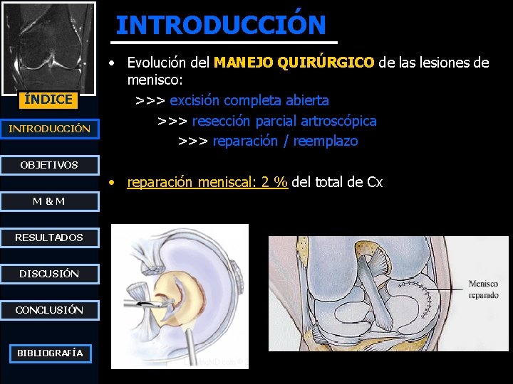 INTRODUCCIÓN ÍNDICE INTRODUCCIÓN • Evolución del MANEJO QUIRÚRGICO de las lesiones de menisco: >>>