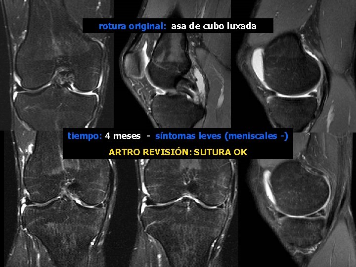 rotura original: asa de cubo luxada tiempo: 4 meses - síntomas leves (meniscales -)