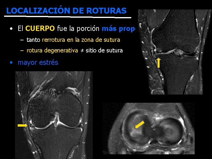 LOCALIZACIÓN DE ROTURAS • El CUERPO fue la porción más propensa al fracaso –