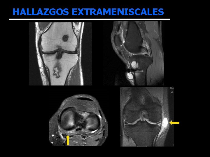 HALLAZGOS EXTRAMENISCALES • ASOCIADOS CON LA REPARACIÓN MENISCAL: – quistes parameniscales: 7 – engrosamiento