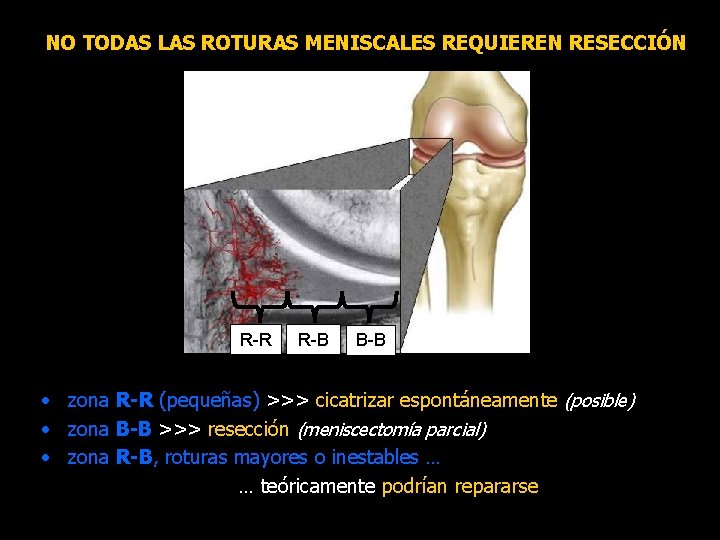 NO TODAS LAS ROTURAS MENISCALES REQUIEREN RESECCIÓN R-R R-B B-B • zona R-R (pequeñas)