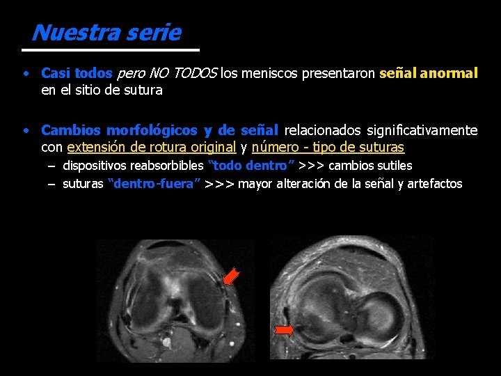 Nuestra serie • Casi todos pero NO TODOS los meniscos presentaron señal anormal en