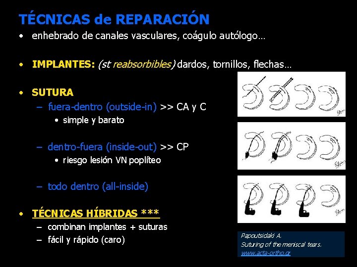 TÉCNICAS de REPARACIÓN • enhebrado de canales vasculares, coágulo autólogo… • IMPLANTES: (st reabsorbibles)