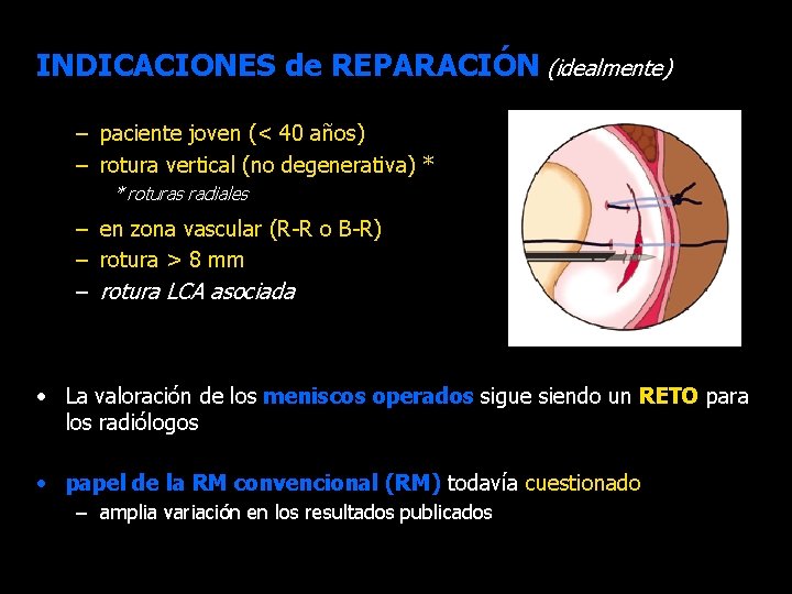 INDICACIONES de REPARACIÓN (idealmente) – paciente joven (< 40 años) – rotura vertical (no