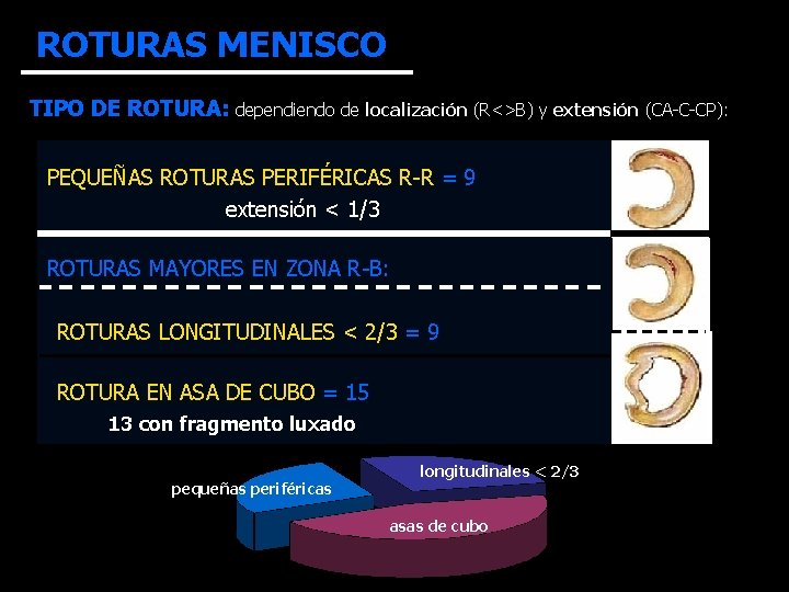 ROTURAS MENISCO TIPO DE ROTURA: dependiendo de localización (R<>B) y extensión (CA-C-CP): PEQUEÑAS ROTURAS