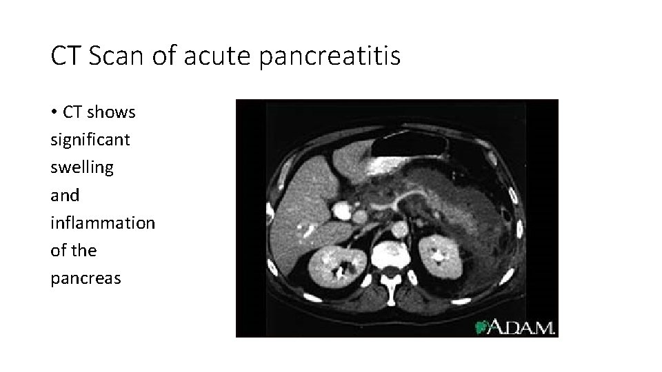 CT Scan of acute pancreatitis • CT shows significant swelling and inflammation of the