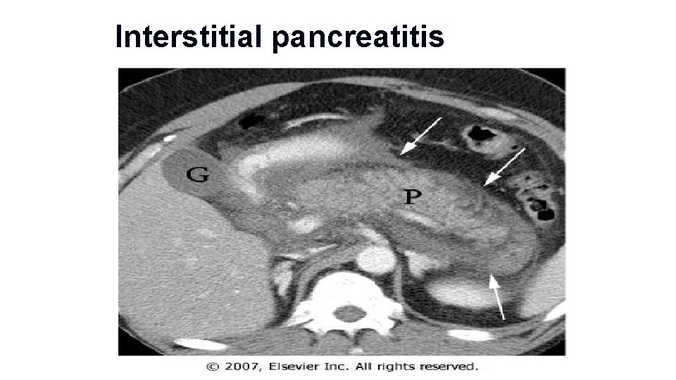 Interstitial pancreatitis 