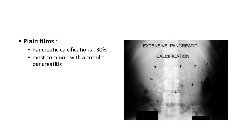  • Plain films : • Pancreatic calcifications : 30% • most common with