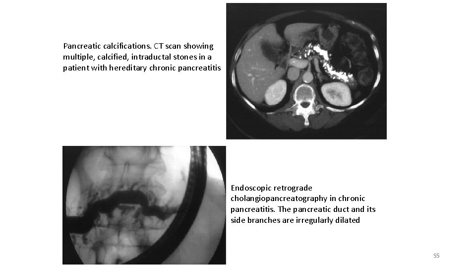 Pancreatic calcifications. CT scan showing multiple, calcified, intraductal stones in a patient with hereditary