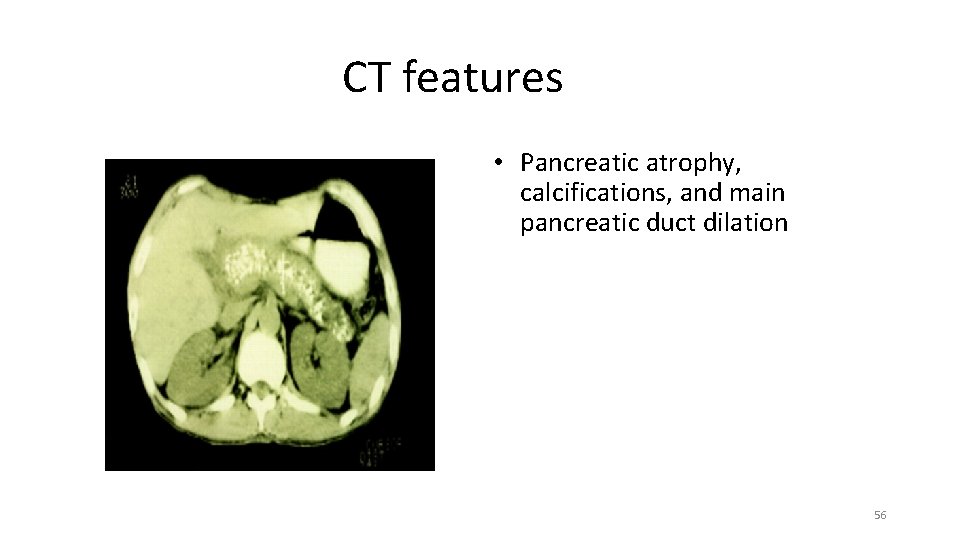 CT features • Pancreatic atrophy, calcifications, and main pancreatic duct dilation 56 