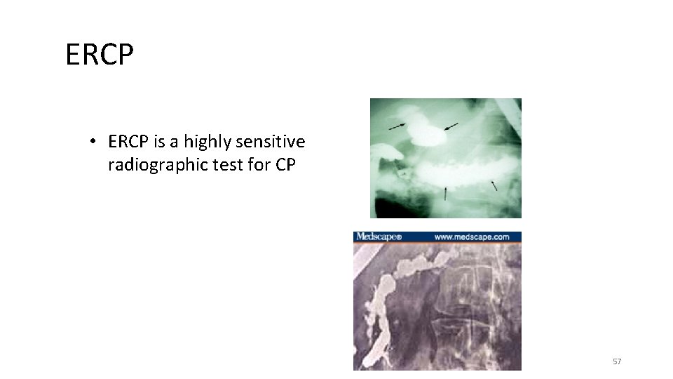 ERCP • ERCP is a highly sensitive radiographic test for CP 57 