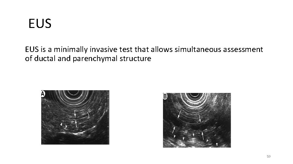 EUS is a minimally invasive test that allows simultaneous assessment of ductal and parenchymal