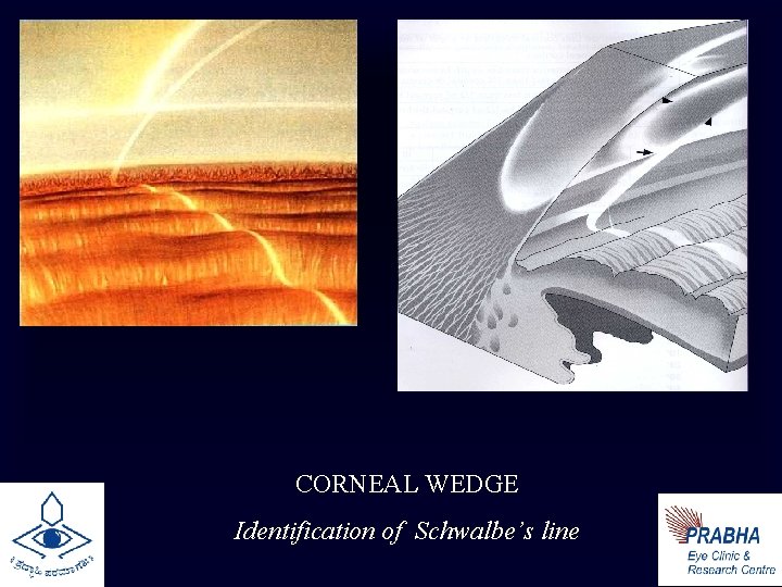 CORNEAL WEDGE Identification of Schwalbe’s line 