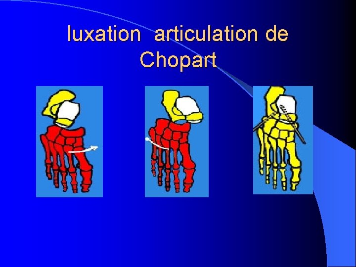 luxation articulation de Chopart 