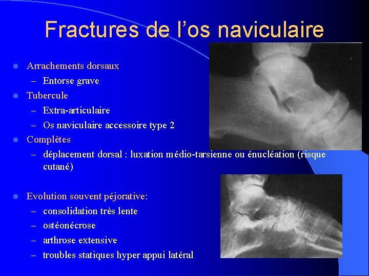 Fractures de l’os naviculaire Arrachements dorsaux – Entorse grave l Tubercule – Extra-articulaire –