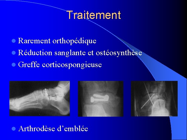 Traitement l Rarement orthopédique l Réduction sanglante et ostéosynthèse l Greffe corticospongieuse l Arthrodèse