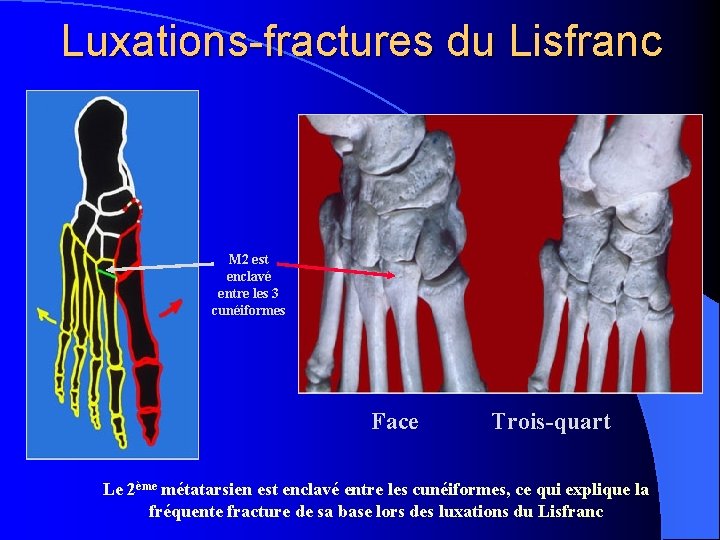 Luxations-fractures du Lisfranc M 2 est enclavé entre les 3 cunéiformes Face Trois-quart Le