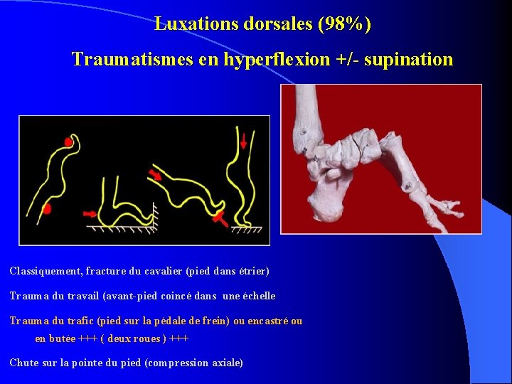 Luxations dorsales (98%) Traumatismes en hyperflexion +/- supination Classiquement, fracture du cavalier (pied dans