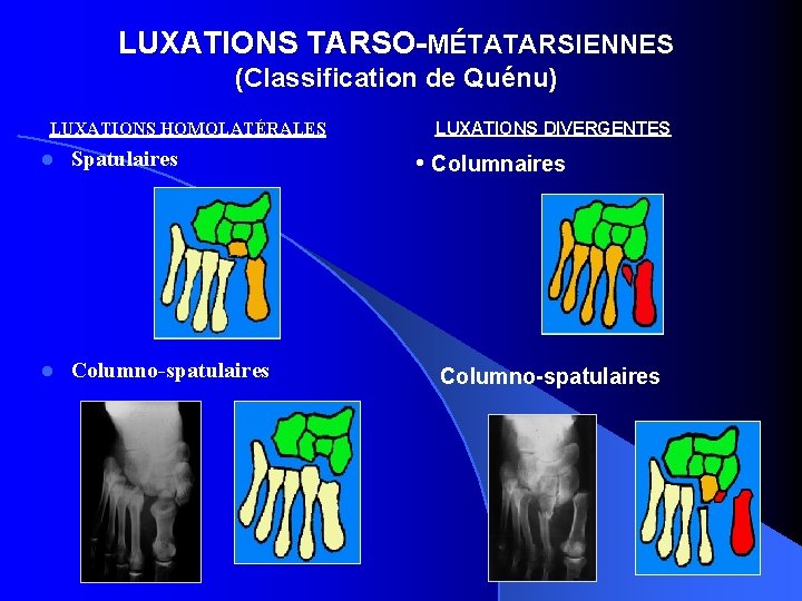 LUXATIONS TARSO-MÉTATARSIENNES (Classification de Quénu) LUXATIONS HOMOLATÉRALES l Spatulaires l Columno-spatulaires LUXATIONS DIVERGENTES •