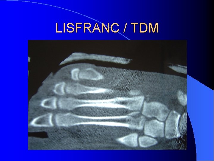 LISFRANC / TDM 