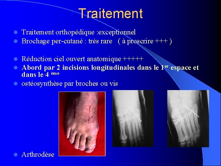 Traitement l l Traitement orthopédique : exceptionnel Brochage per-cutané : très rare ( à