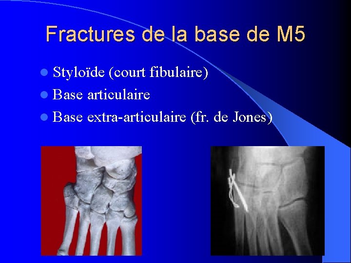 Fractures de la base de M 5 l Styloïde (court fibulaire) l Base articulaire