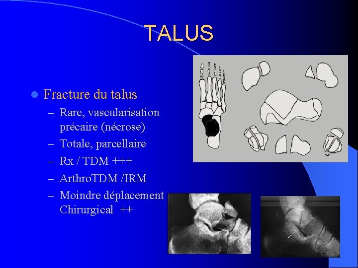 TALUS l Fracture du talus – Rare, vascularisation – – précaire (nécrose) Totale, parcellaire