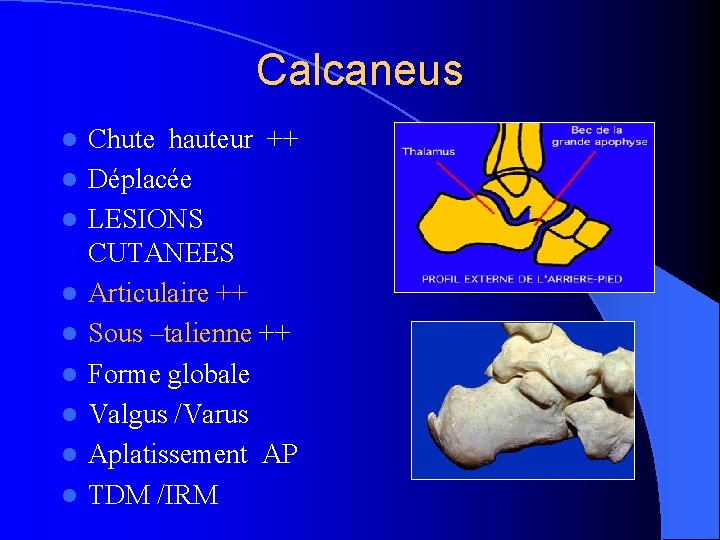 Calcaneus l l l l l Chute hauteur ++ Déplacée LESIONS CUTANEES Articulaire ++