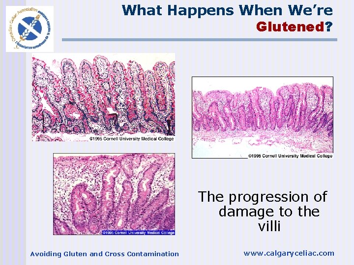 What Happens When We’re Glutened? The progression of damage to the villi Avoiding Gluten